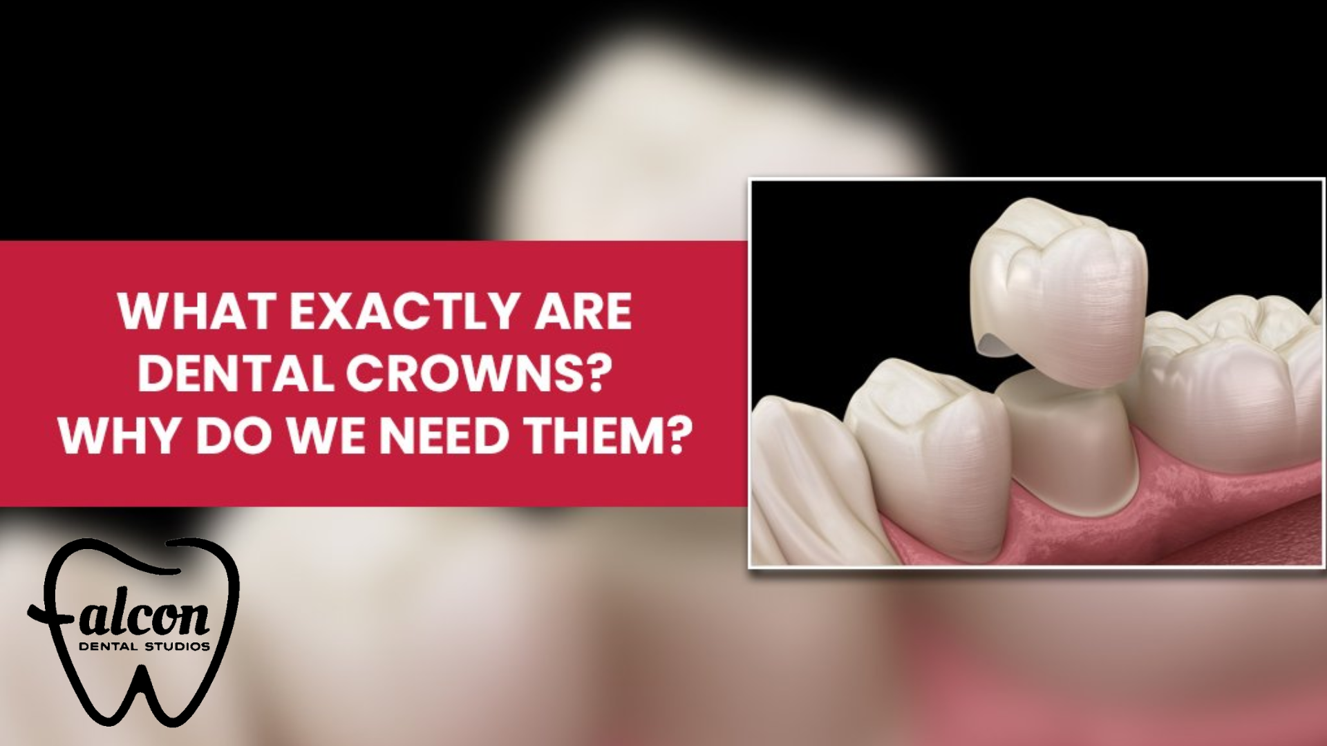 Understanding Dental Crowns: When and Why You Need Them - Falcon Dental Studios